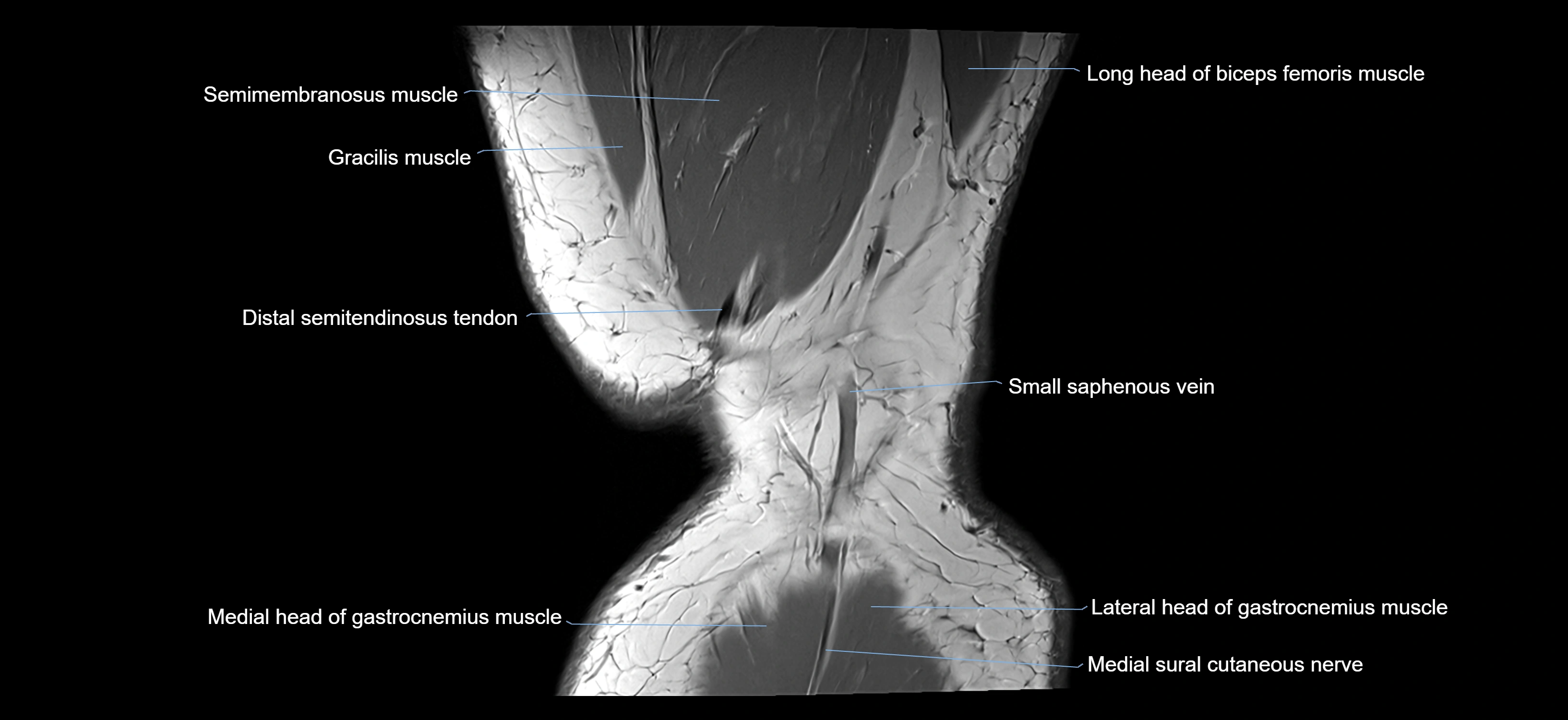 MRI knee coronal cross sectional anatomy labelled 3T radiology  image-04001-00044.webp